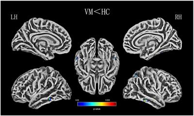 Cortical Areas Associated With Multisensory Integration Showing Altered Morphology and Functional Connectivity in Relation to Reduced Life Quality in Vestibular Migraine